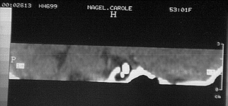 Implant in Pituitary Cavity